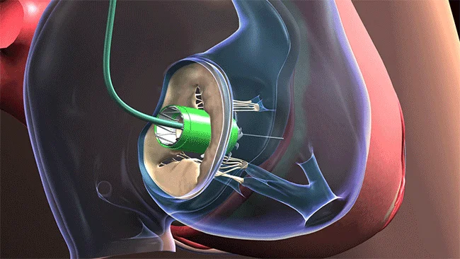 Biohybrid Heart Valve